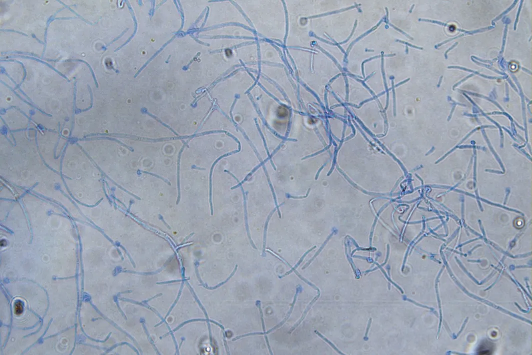 Talaromyces Marneffei (داء التالاروميكوسيس) — مرجع سريع